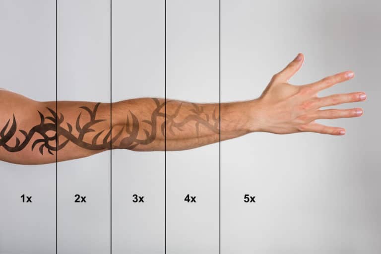 Stages Of Tattoo Removal 768x512 